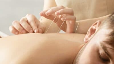 young man getting acupuncture treatment